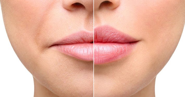 Trattamento per le labbra: come scegliere il filler più adatto