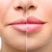 Trattamento per le labbra: come scegliere il filler più adatto