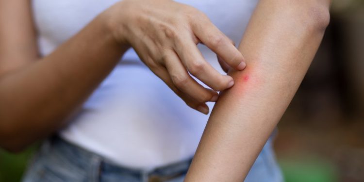 Puntura di zanzara: cosa fare e cosa non fare