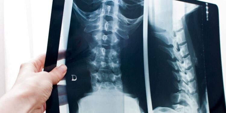 Radiografia dorsale, ecco perchè è importante nella diagnosi di patologie della colonna vertebrale