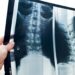 Radiografia dorsale, ecco perchè è importante nella diagnosi di patologie della colonna vertebrale
