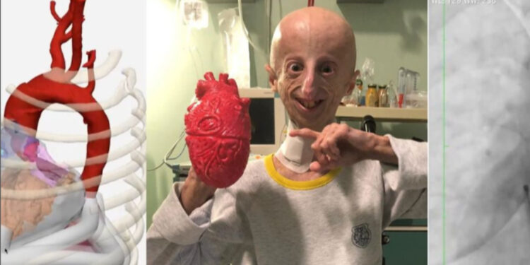 È morto all’età di 28 anni Sammy Basso, il malato di progeria il più longevo al mondo