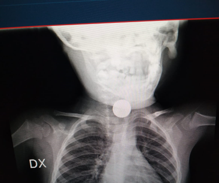 Ingerisce pila a disco, bimbo di due anni operato d’urgenza al Santobono