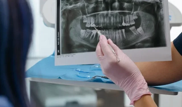 Implantologia dentale: tutte le informazioni utili