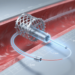 Vantaggi del Nitinol per la produzione di dispositivi mini-invasivi